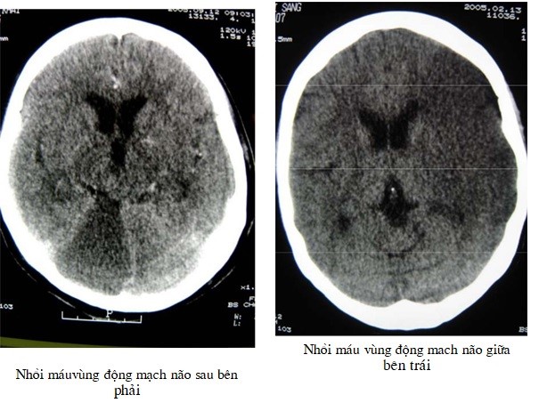 Hình ảnh chụp CT nhồi máu não