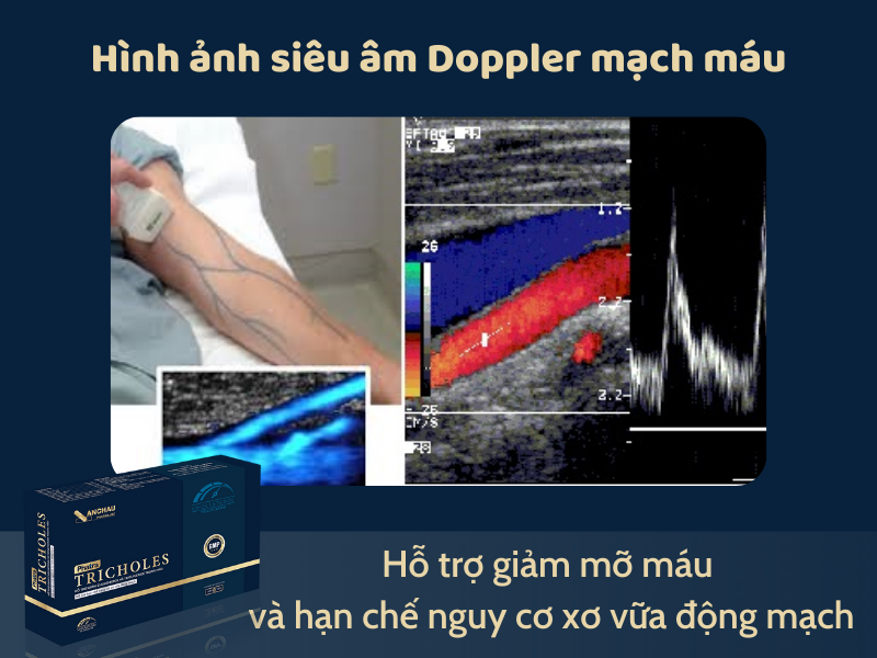 Hình ảnh siêu âm Doppler mạch máu