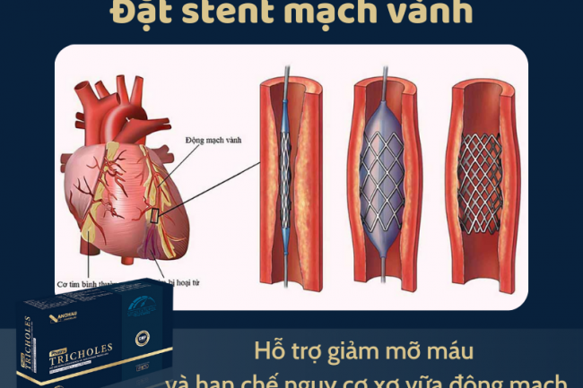 Đặt stent mạch vành