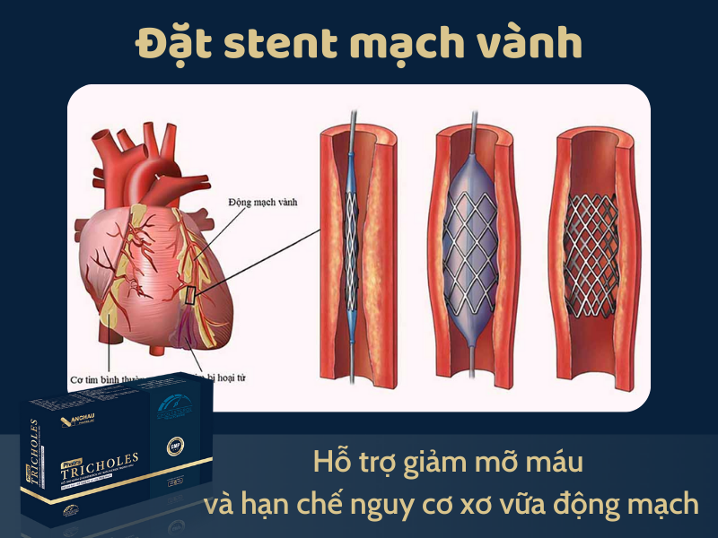 Đặt stent mạch vành
