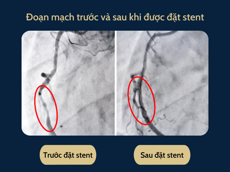 Hình ảnh đặt stent mạch vành